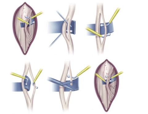 Qué es la rizotomía dorsal selectiva